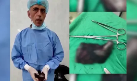 Γάζα: Θραύσμα οβίδας βάρους 1 κιλού αφαιρέθηκε από τραυματία