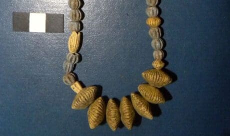 Σύνδρομο Down βρέφος Ελλάδα