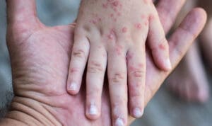Ιλαρά: Τα πρώτα συμπτώματα που μοιάζουν με απλό κρυολόγημα – Πότε εμφανίζεται το εξάνθημα