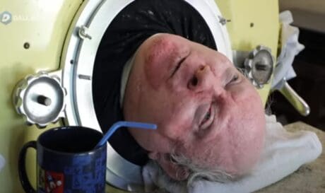 «Έφυγε» από την ζωή ο άντρας που ζούσε επί 70 χρόνια με σιδερένιο πνέυμονα (βίντεο)