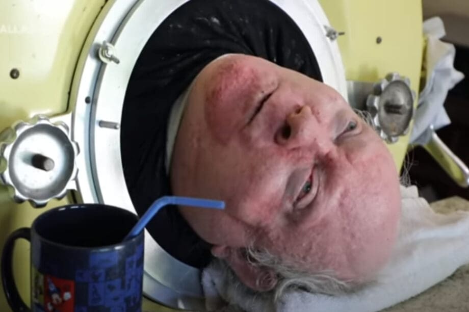 «Έφυγε» από την ζωή ο άντρας που ζούσε επί 70 χρόνια με σιδερένιο πνέυμονα (βίντεο)