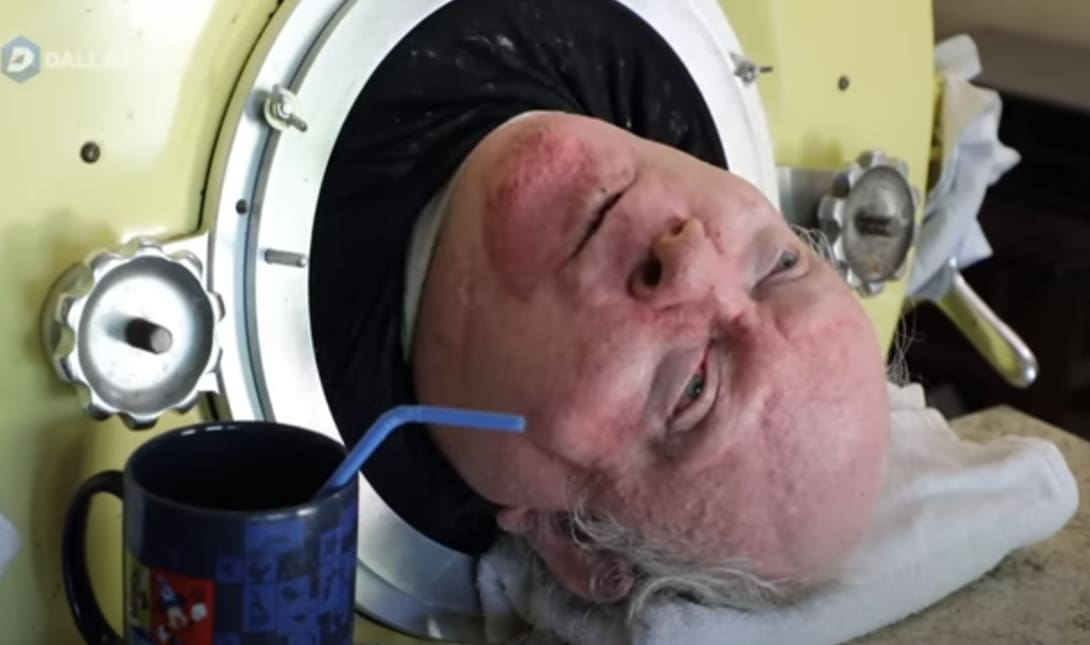 «Έφυγε» από την ζωή ο άντρας που ζούσε επί 70 χρόνια με σιδερένιο πνέυμονα (βίντεο)