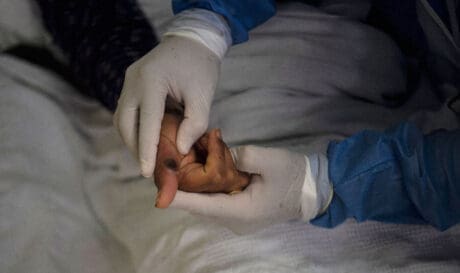 Ευλογιά των πιθήκων