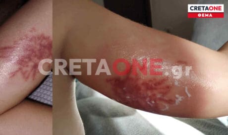 τσίμπημα θαλάσσιας ανεμώνης