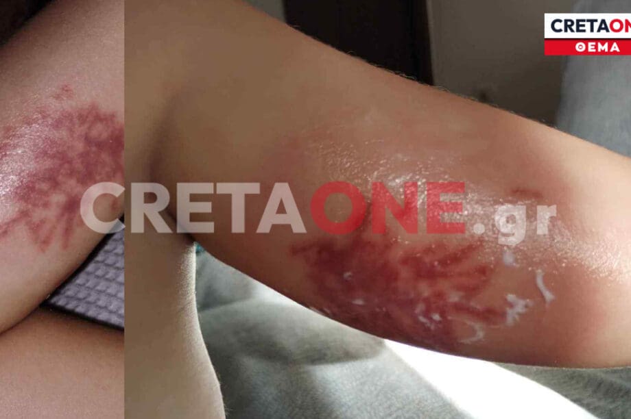 τσίμπημα θαλάσσιας ανεμώνης