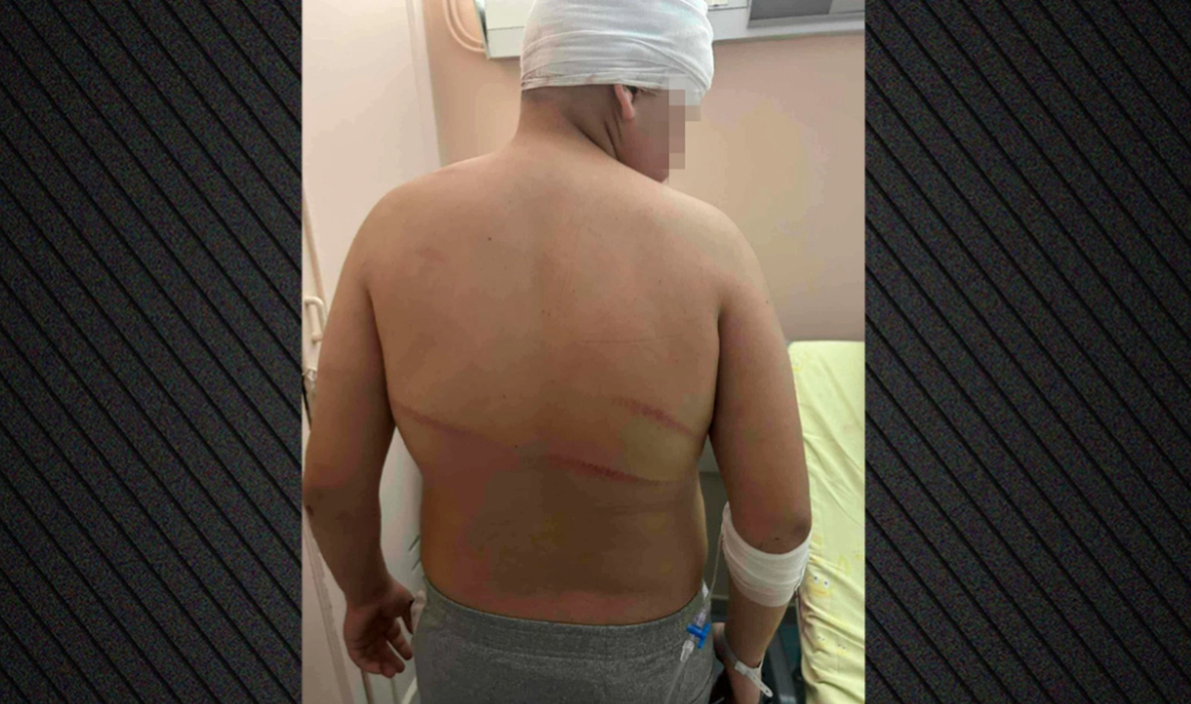 «Το παιδί μου ζει από θαύμα»: Σοκάρουν οι φωτογραφίες του 13χρονου που έφαγε ξύλο με μπετόβεργες