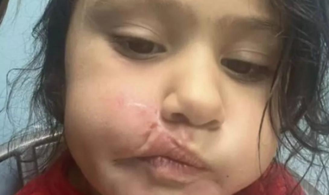 Pit bull επιτέθηκε σε 4χρονη και της «έσκισε» το πρόσωπο – Δείτε φωτογραφίες