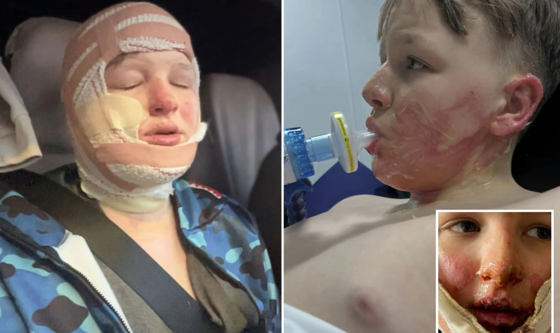 Αγγλία: Φρικτός τραυματισμός μαθητή από ανάφλεξη δοχείου αεροζόλ