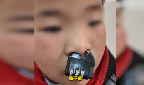 Πιτσιρικάς σφήνωσε λουκέτο στη... μύτη του και χρειάστηκαν Πυροσβέστες με κόφτη για να το αφαιρέσουν (βίντεο)