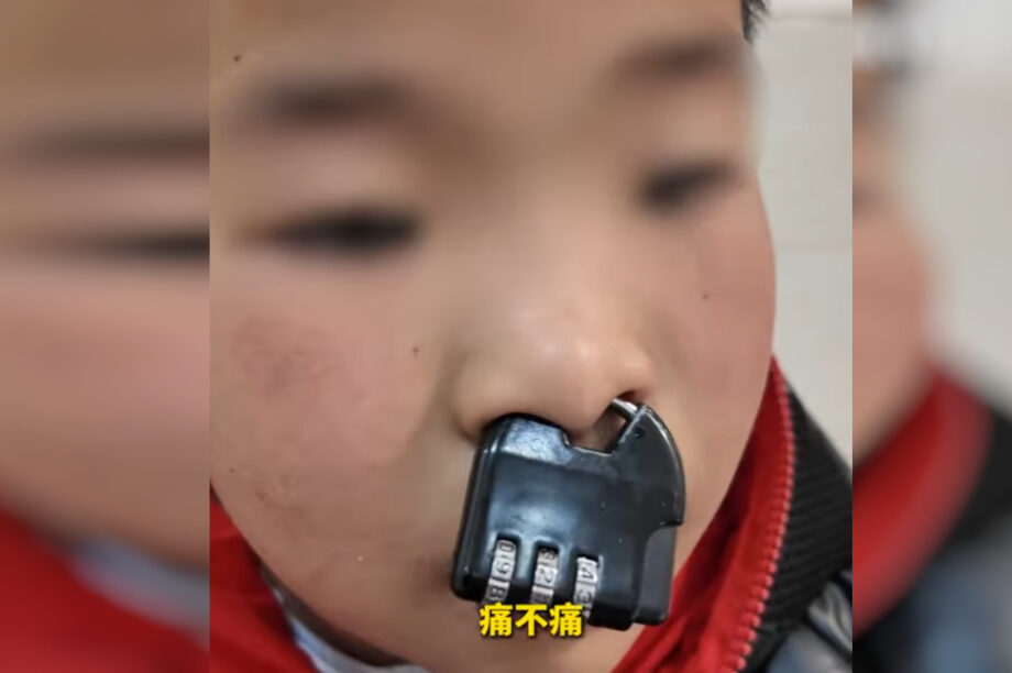 Πιτσιρικάς σφήνωσε λουκέτο στη... μύτη του και χρειάστηκαν Πυροσβέστες με κόφτη για να το αφαιρέσουν (βίντεο)