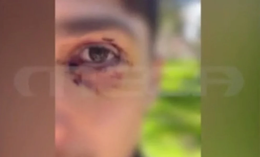 Ιωάννινα: Με μόνιμη βλάβη στο μάτι ο 16χρονος που ξυλοκοπήθηκε από ανήλικους