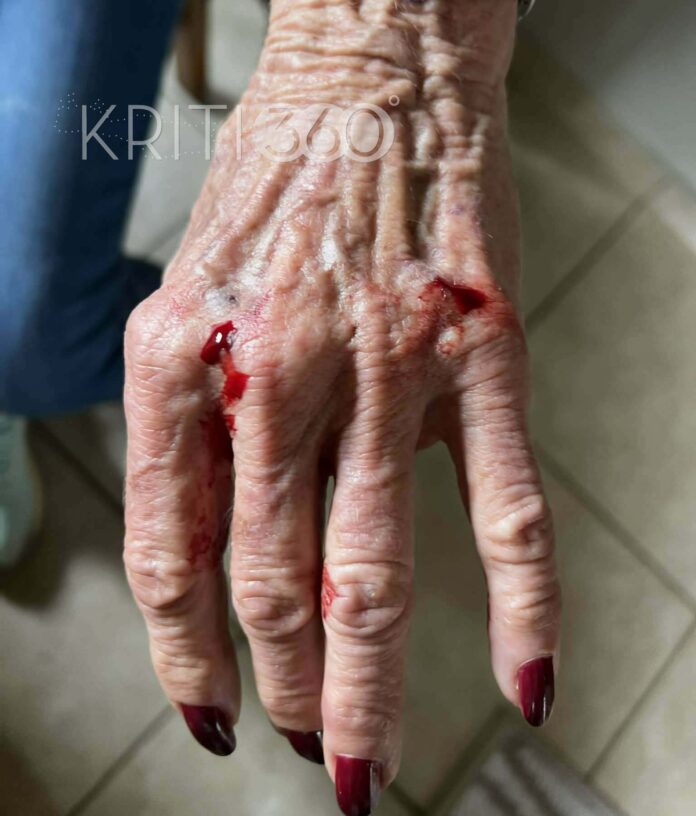 Τρόμος στην Κρήτη: Δύο μεγαλόσωμα σκυλιά επιτέθηκαν σε 76χρονη – Την έστειλαν στο νοσοκομείο - Σοκαριστικές εικόνες