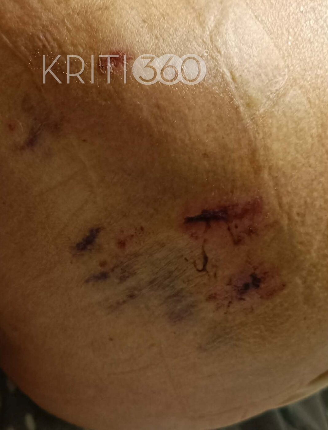 Τρόμος στην Κρήτη: Δύο μεγαλόσωμα σκυλιά επιτέθηκαν σε 76χρονη – Την έστειλαν στο νοσοκομείο - Σοκαριστικές εικόνες