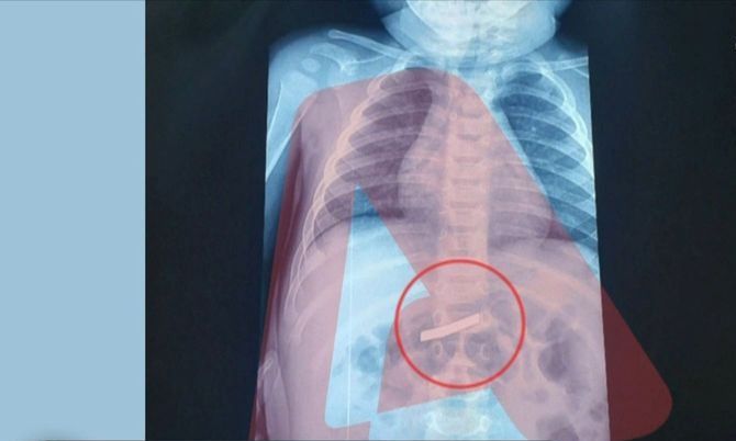 Ώρες αγωνίας για αγοράκι 3 ετών στην Αθήνα – Κατάπιε ξυραφάκι