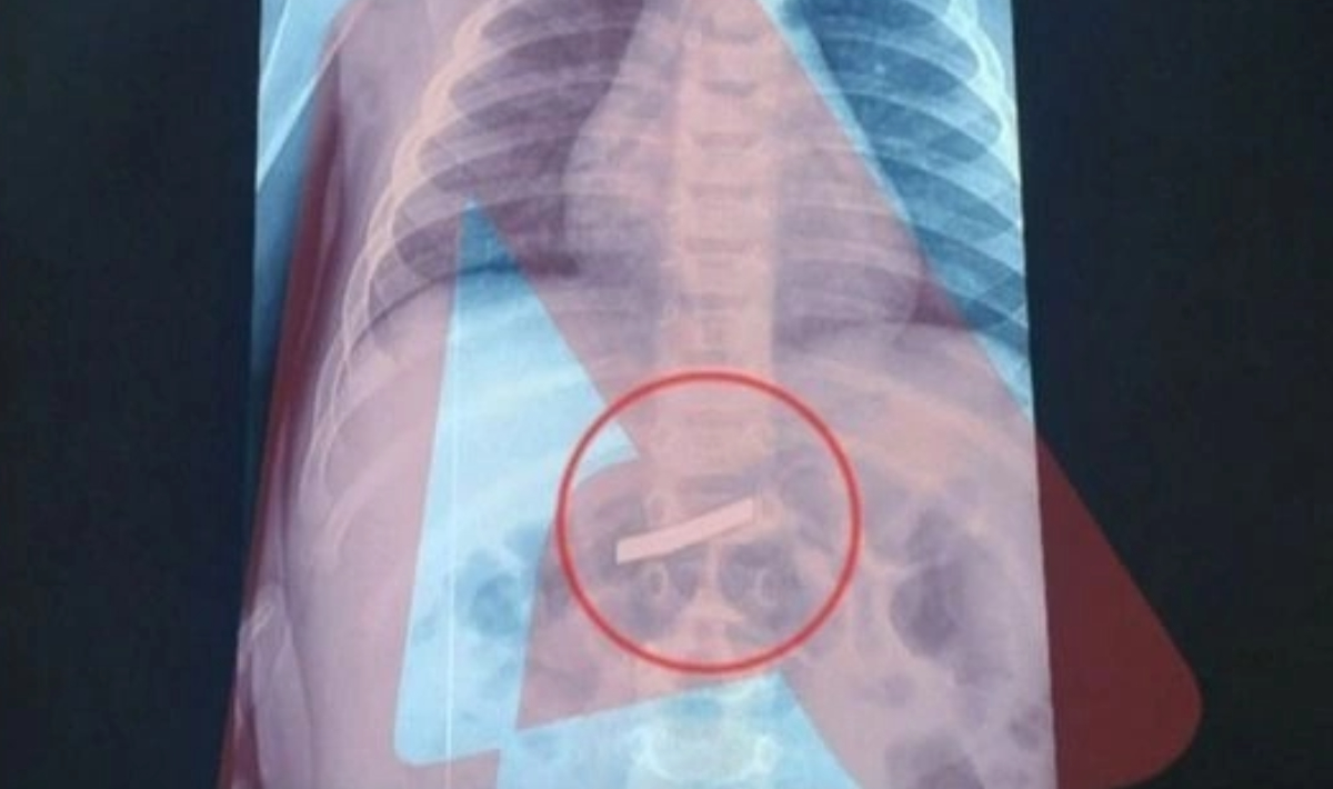 Επιτυχημένο το χειρουργείο για το 3χρονο παιδί που κατάπιε ξυραφάκι – Αναρρώνει πλέον στο σπίτι