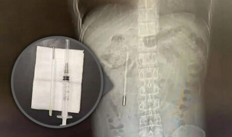 Κίνα: Βρέθηκε θερμόμετρο στο στομάχι 32χρονου που το είχε καταπιεί πριν 20 χρόνια!