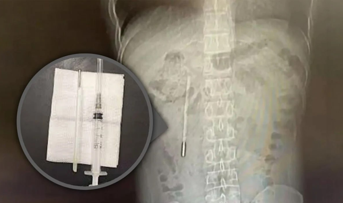 Κίνα: Βρέθηκε θερμόμετρο στο στομάχι 32χρονου που το είχε καταπιεί πριν 20 χρόνια!
