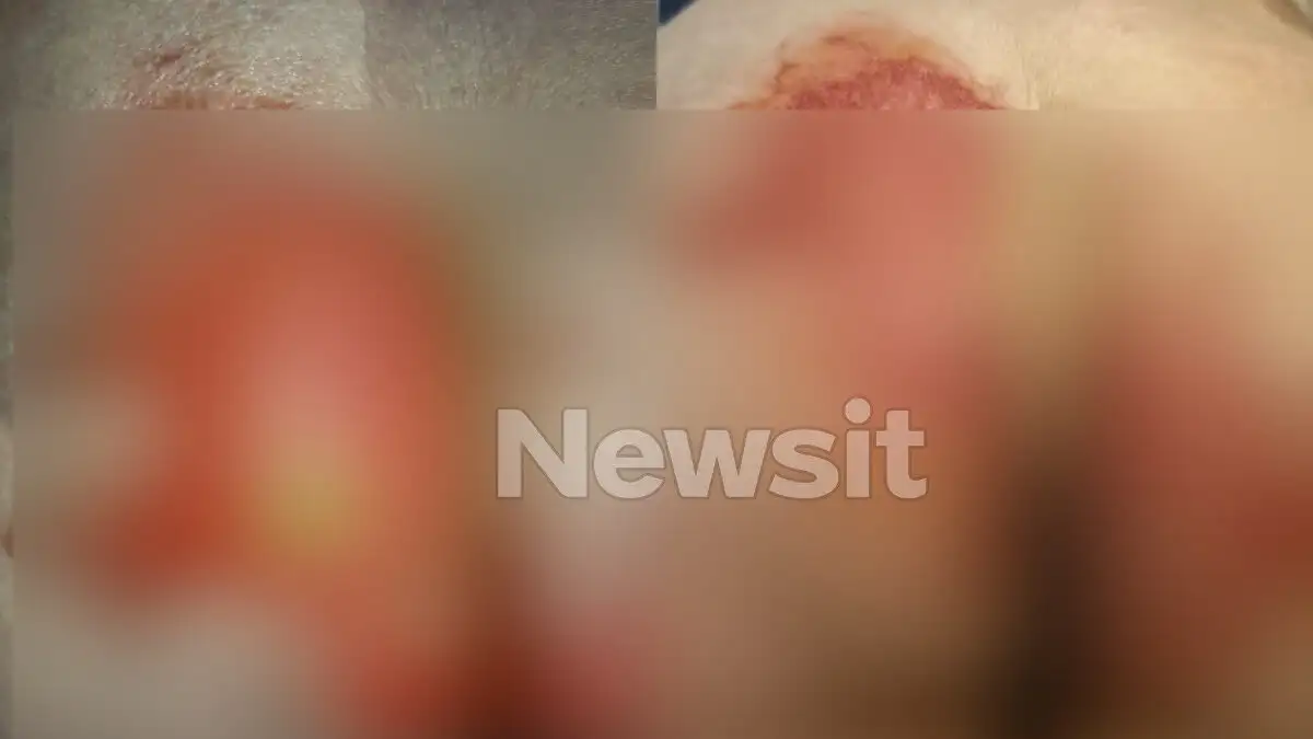 Θεσσαλονίκη: 52χρονη υπέστη χημικά εγκαύματα στα γεννητικά όργανα μετά από εξέταση – «Της έριξαν οξύ και της έλεγαν ότι έχει αλλεργία»